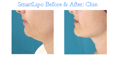 smart lipo before after