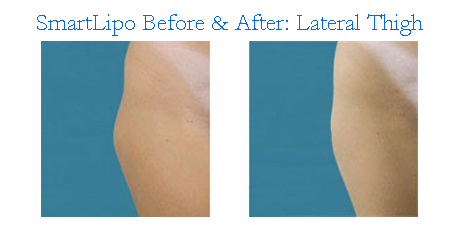 smart lipo before after